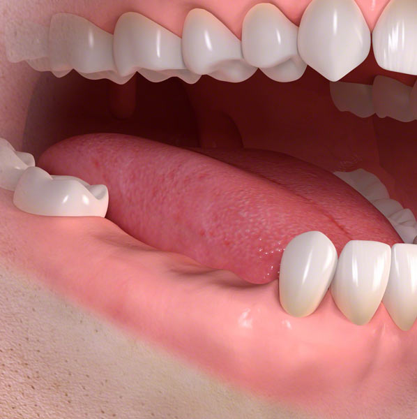 teeth dental implants
