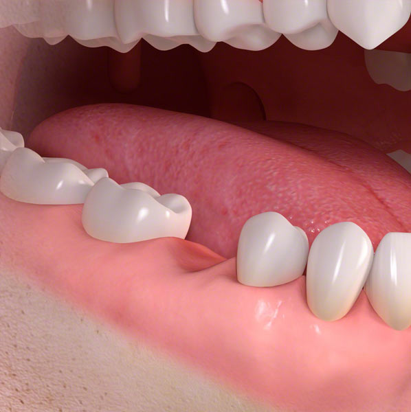 teeth dental implants