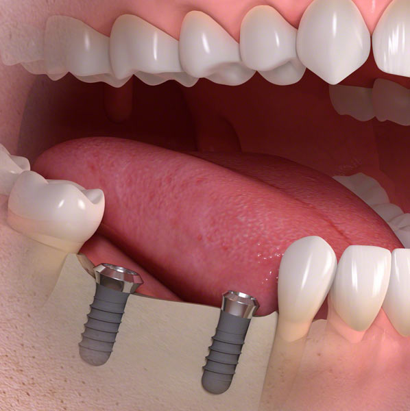 teeth dental implants