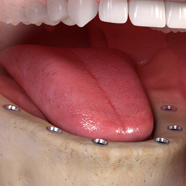 teeth dental implants