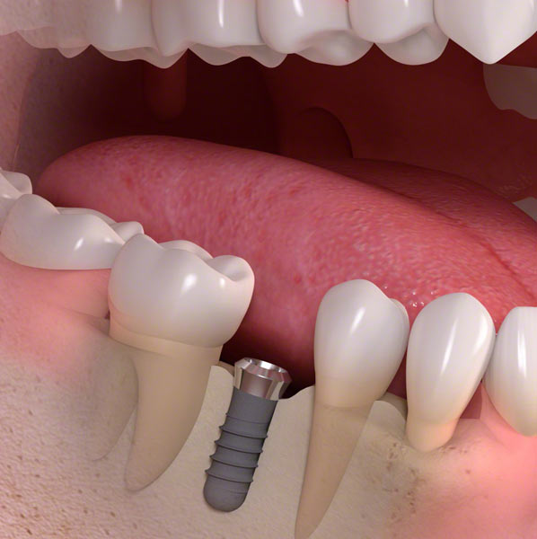 teeth dental implants