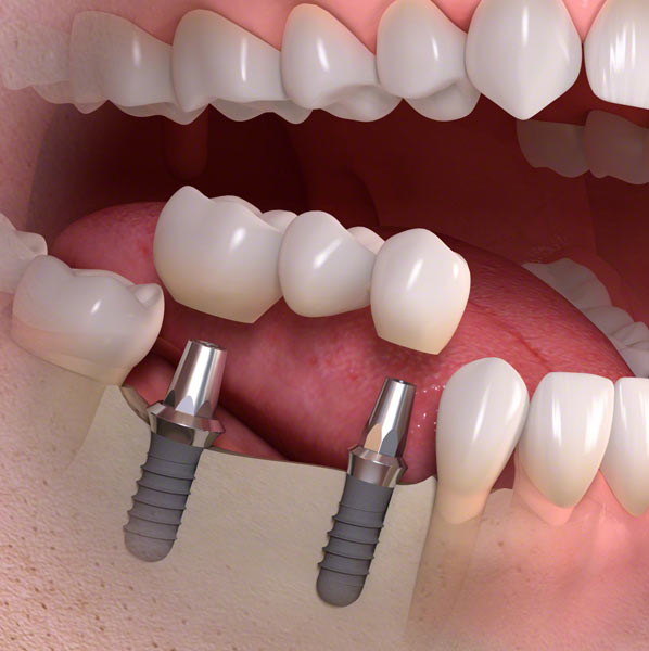 teeth dental implants