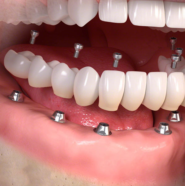 teeth dental implants