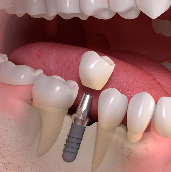 teeth dental implants
