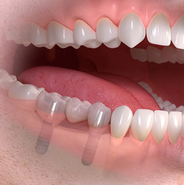 teeth dental implants